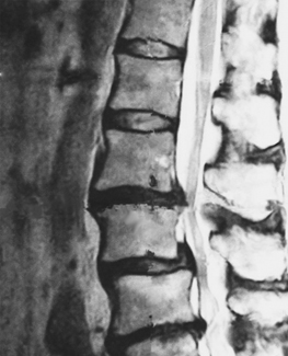 腰部脊柱管狭窄症の原因